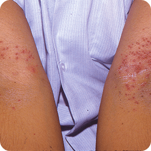 あせも（汗疹）