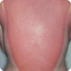 日焼け（日光皮膚炎）