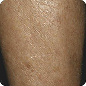 乾燥肌（ドライスキン）