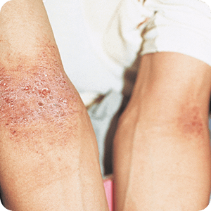 アトピー性皮膚炎