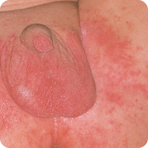 おむつかぶれ（おむつ皮膚炎）