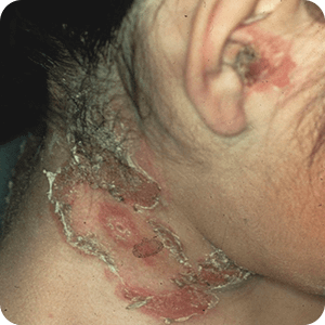 とびひ（伝染性膿痂疹）