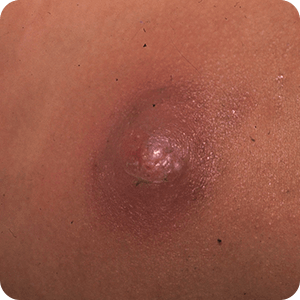 粉瘤（アテローム）