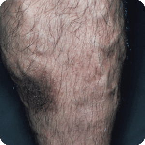 うっ滞性皮膚炎（下肢静脈瘤）