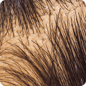 トンズランス感染症