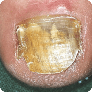 爪白癬（爪水虫）