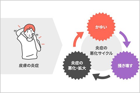 
ステロイド外用剤と皮膚トラブル