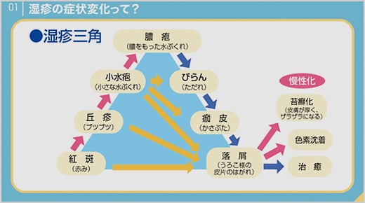 湿疹三角と炎症の悪化サイクル