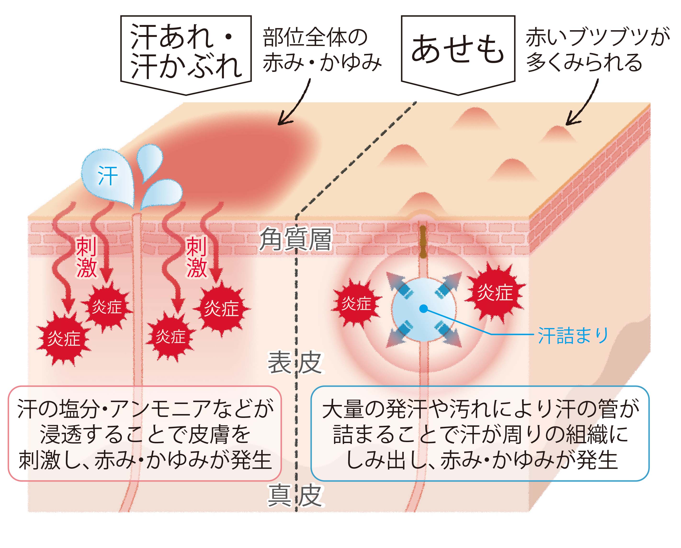 汗によるかぶれとあせもの違い(出典 田辺ファーマ)