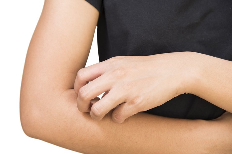 「あせも」だけじゃない？汗による皮膚トラブル