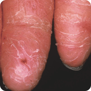 洗剤かぶれの症例画像 皮膚が乾燥してはがれ落ちた指の腹