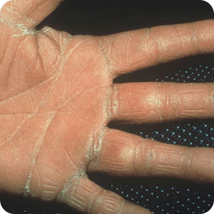 手の水虫(手白癬)の症例画像