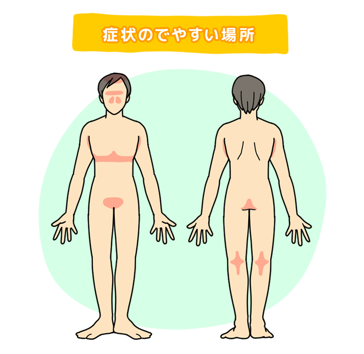 症状のでやすい場所を示した図。頭部は頭皮や鼻周り、胸部やわき、股間部、膝の裏などが症状がでやすい。