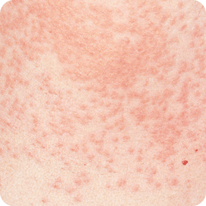 チャドクガ（毛虫）による虫刺されの症例画像