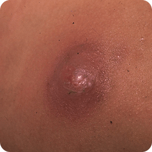 ドーム状に盛り上がった皮膚