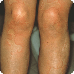 蕁麻疹の症例画像