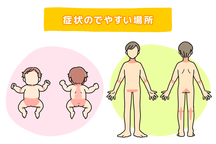 あせものできやすい場所