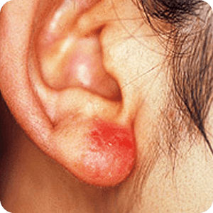 接触皮膚炎の症例画像 イヤリングによる接触皮膚炎