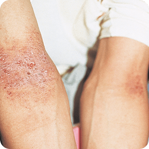 左右対称の皮膚炎・かぶれの症例画像