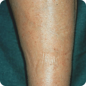 皮脂欠乏性湿疹（乾燥湿疹）の症例画像