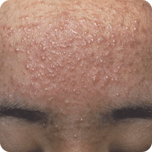 ニキビの症例画像