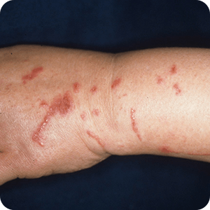 接触皮膚炎の症例画像 植物による接触皮膚炎