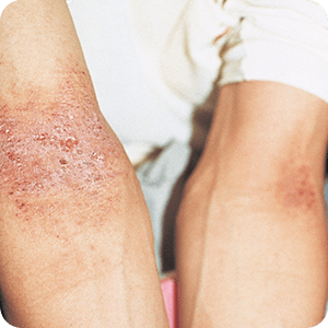 アトピー性皮膚炎 症例画像:左右対称の皮膚炎・かぶれ