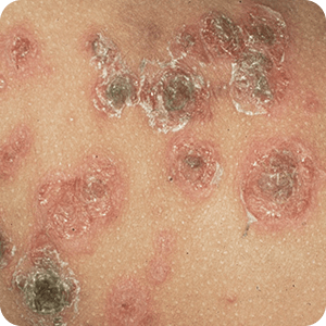 痂皮性のとびひ(かさぶたができる)