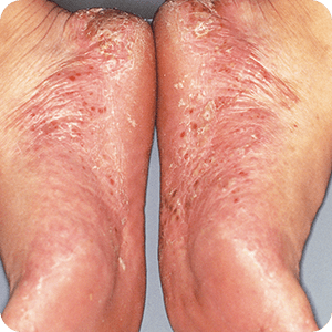 土踏まずからかかとまで多数の水疱が発生した足の裏