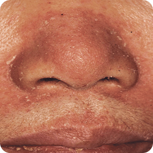 脂漏性皮膚炎の症例画像 鼻のわきに赤みを帯びた湿疹ができている