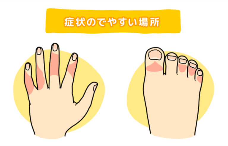 症状のでやすい場所として、手や足の指、特に関節周りを示した図
