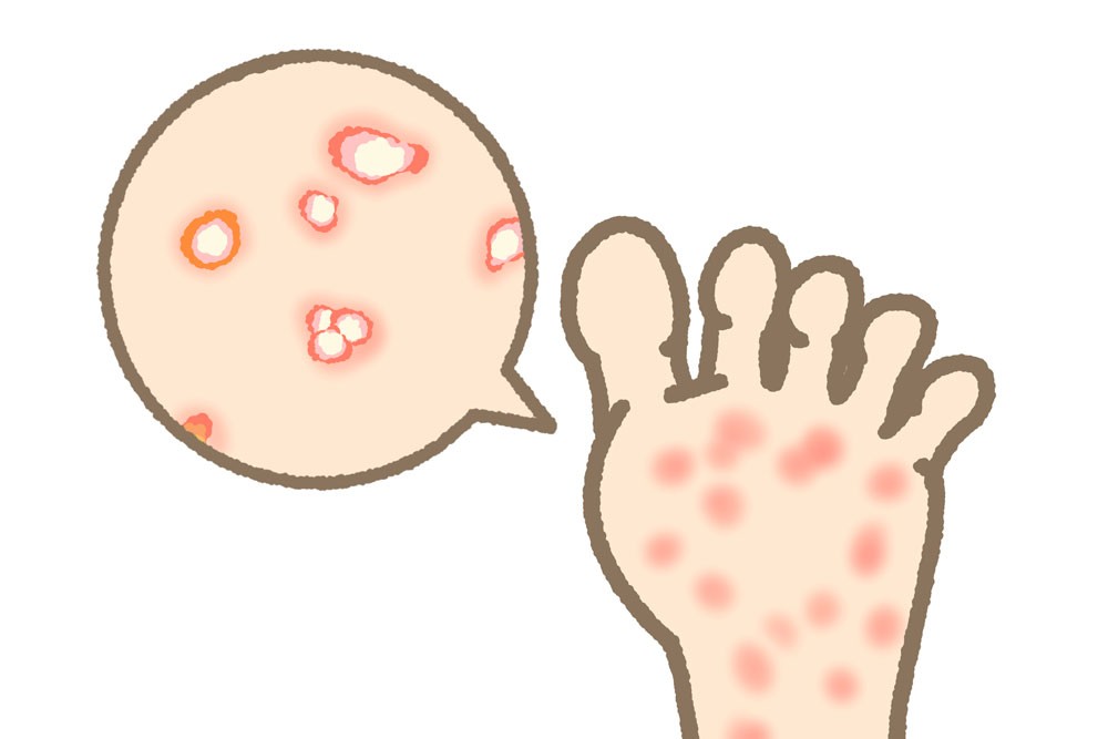 水虫と間違えやすい水ぶくれ。なかなか治らない原因とその対処法