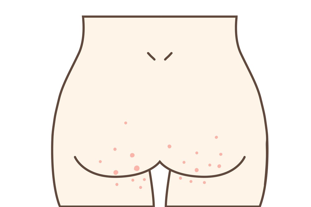 洗いすぎも原因に？-おしりのブツブツの正体