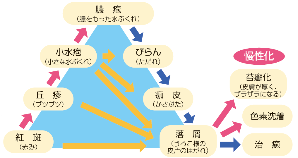 湿疹は「紅斑」「丘疹」「小水疱」「膿疱」から「びらん」「痂皮」「落屑」を経て治癒します。場合によっては慢性化し「苔癬化」「色素沈着」となることもあります。この湿疹が進行する過程は三角形の図で表され、「湿疹三角」と呼びます。