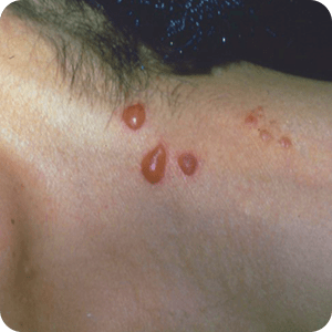 アオカミキリモドキによる虫刺されの症例画像