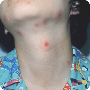 ブユによる虫刺されの症例画像