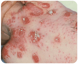 貨幣状湿疹の症例画像 大きな円形の湿疹が体に多数広がっており、一部はかさぶたのようになっている