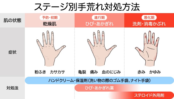 ステージ別手荒れ対処方法 肌の状態:乾燥肌(予防・初期) 症状:粉ふき・カサカサ 対処法:ハンドクリーム・保湿剤(洗い物の際のゴム手袋、ナイト手袋) 肌の状態:ひび・あかぎれ(進行期) 症状:亀裂・痛み・血のにじみ 対処法:ハンドクリーム・保湿剤・ひび/あかぎれ薬 肌の状態:洗剤・消毒かぶれ(悪化期) 症状:赤み・かゆみ 対処法:ハンドクリーム・保湿剤・ひび/あかぎれ薬・ステロイド外用剤