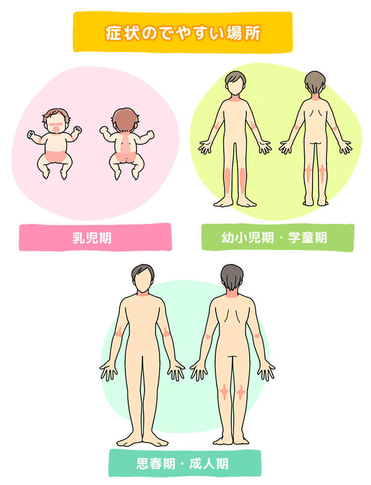 乳児期、幼・小児期、思春期・成人期別に症状が出やすい部位を示した図