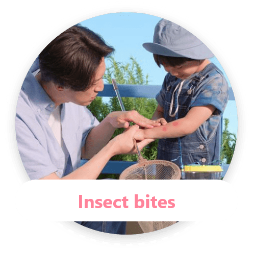 Insect bites