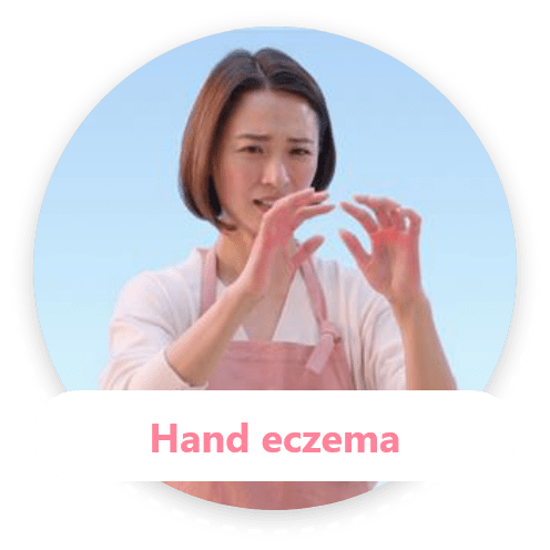 Hand eczema