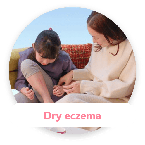 Dry eczema