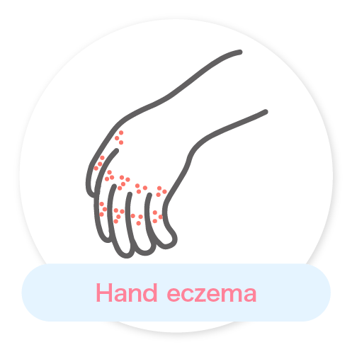 Hand eczema