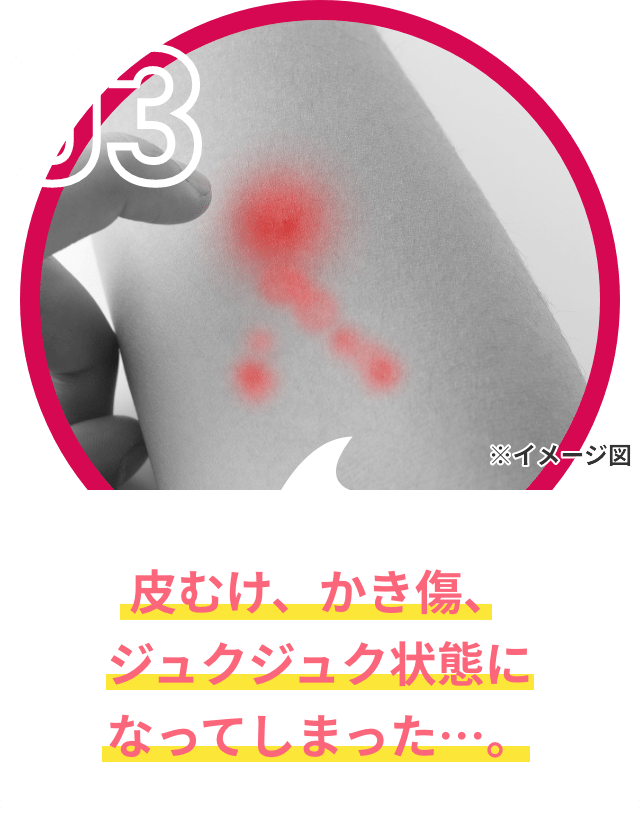 皮むけ、かき傷、ジュクジュク状態になってしまった…。