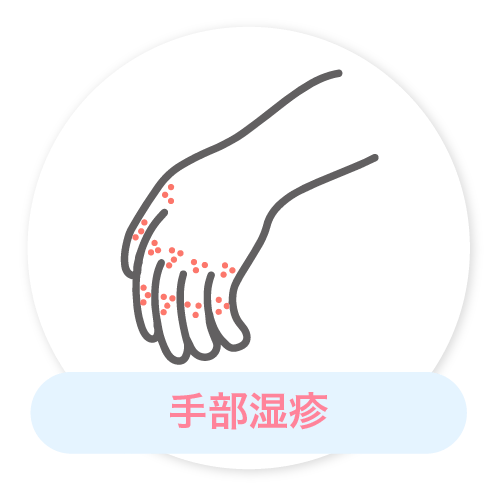 手部湿疹