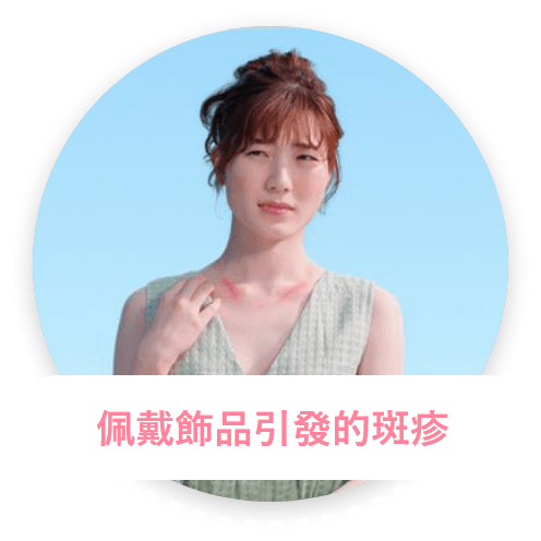 佩戴飾品引發的斑疹