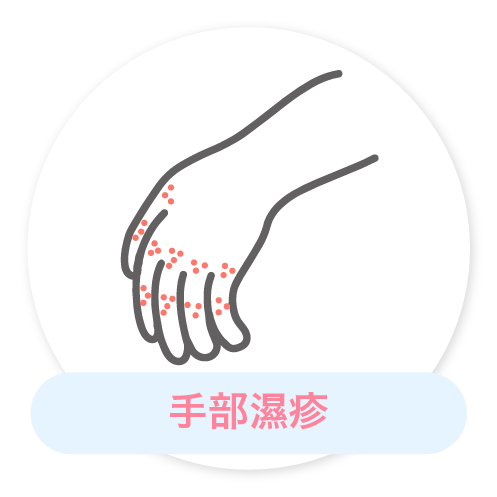 手部濕疹