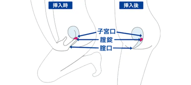 腟錠 挿入法 図
