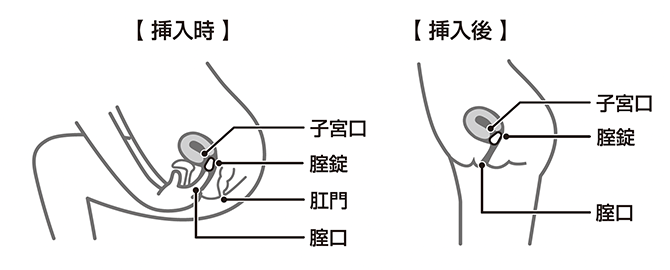 腟錠 挿入法 図